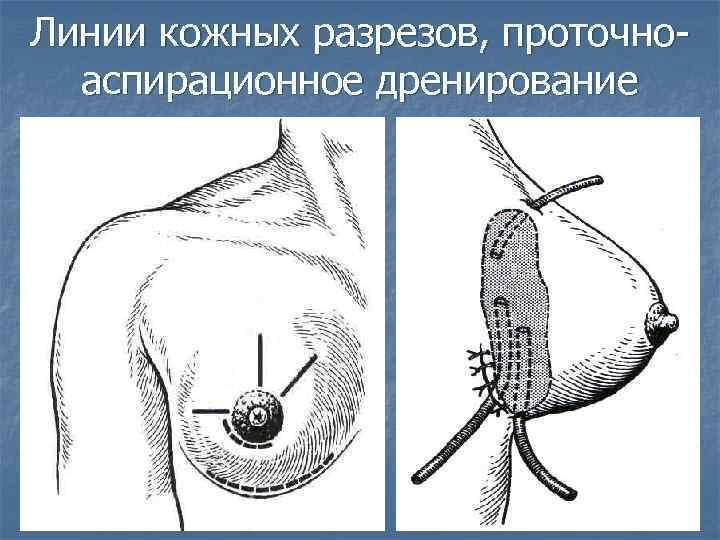 Линии кожных разрезов, проточноаспирационное дренирование 