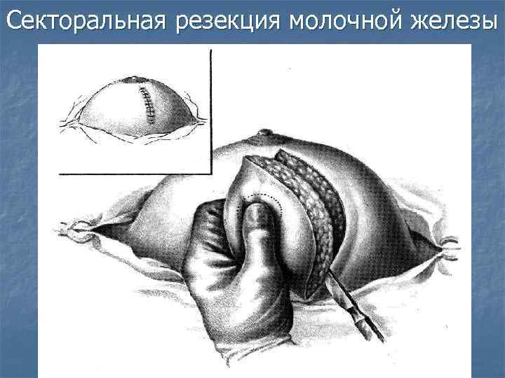 Секторальная резекция молочной железы 