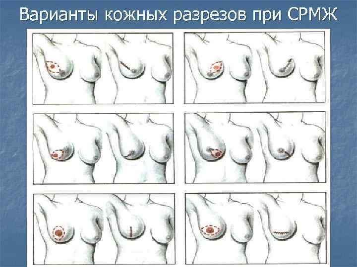 Варианты кожных разрезов при СРМЖ 