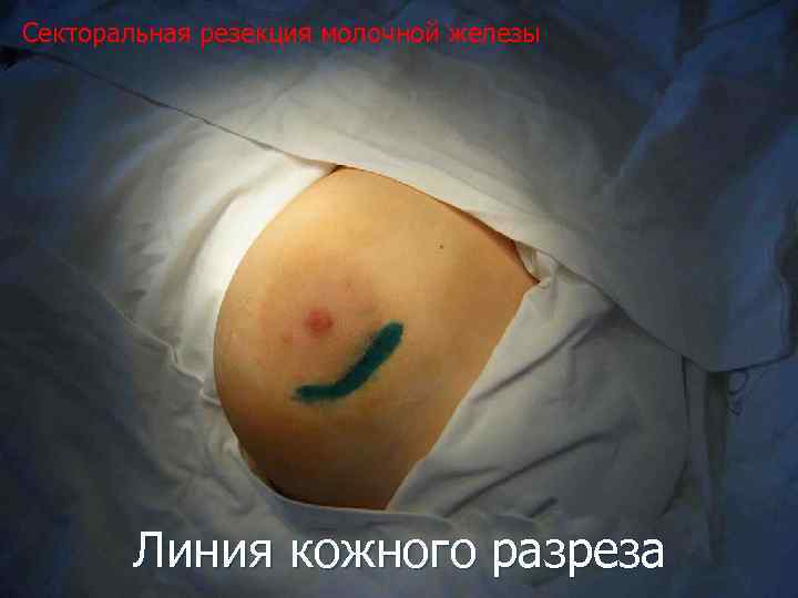 Секторальная резекция молочной железы Линия кожного разреза 