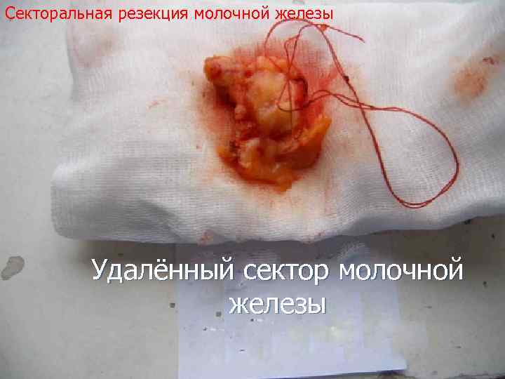 Секторальная резекция молочной железы Удалённый сектор молочной железы 