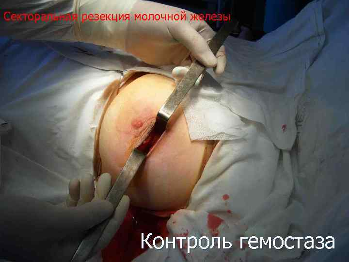 Секторальная резекция молочной железы Контроль гемостаза 