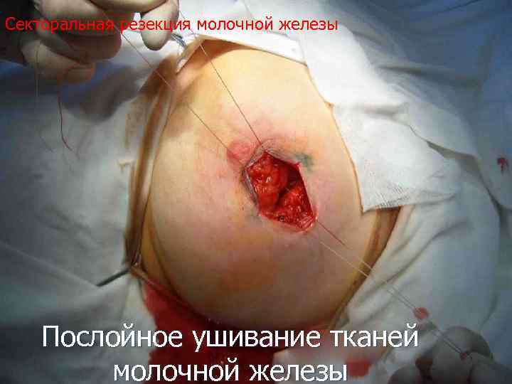 Секторальная резекция молочной железы Послойное ушивание тканей молочной железы 