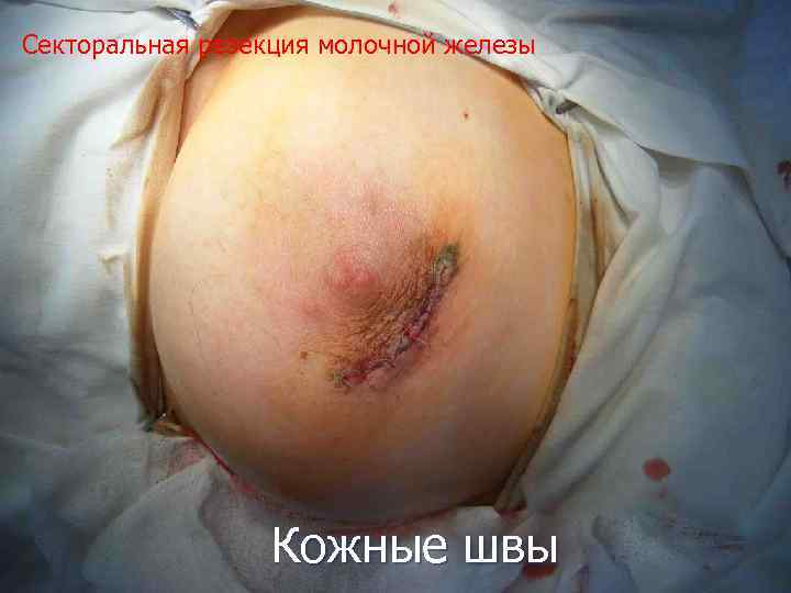 Секторальная резекция молочной железы Кожные швы 