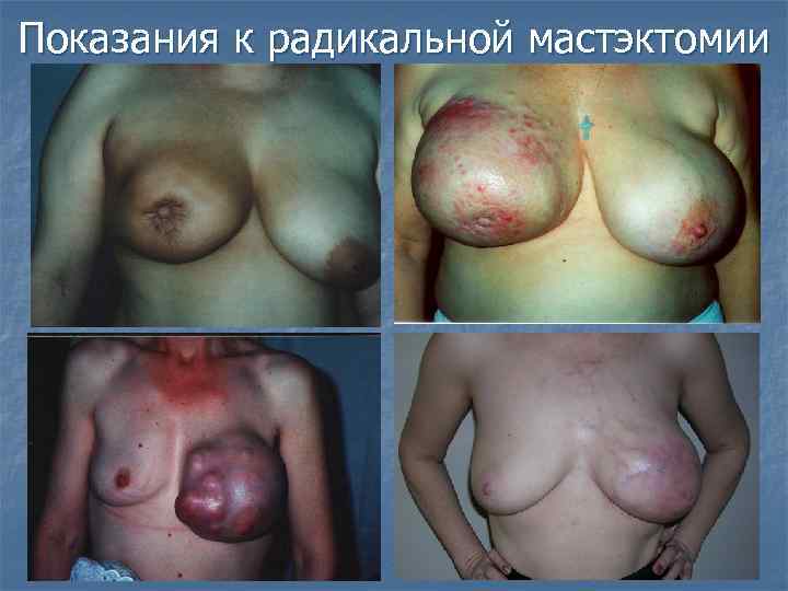 Показания к радикальной мастэктомии 