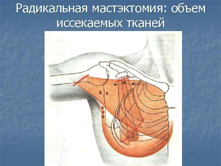 Радикальная мастэктомия. Мастэктомия по Холстеду-Майеру. Радикальная мастэктомия по Холстеду. Мастэктомия ход операции. Радикальная мастэктомия топографическая анатомия.