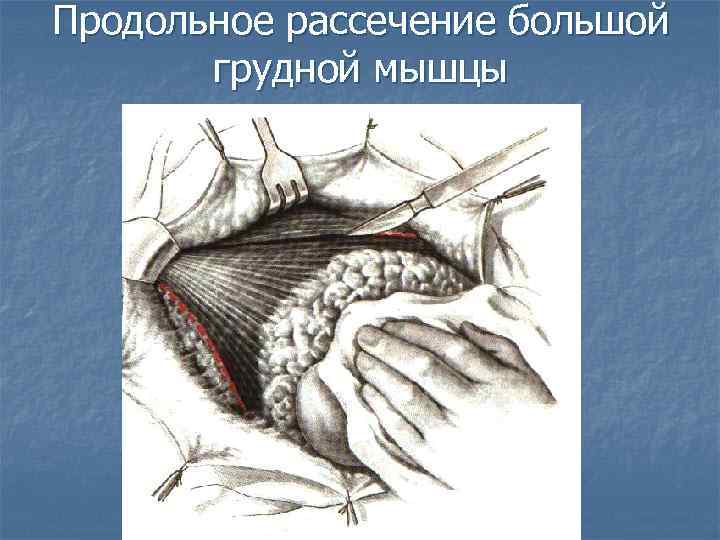 Продольное рассечение большой грудной мышцы 
