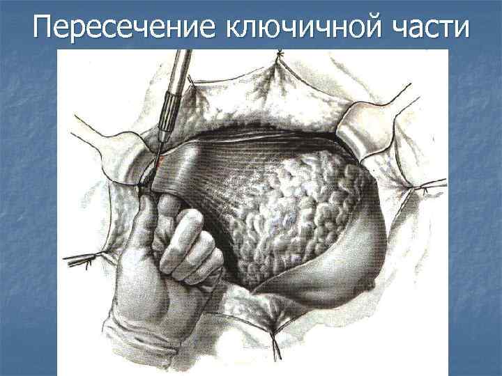 Пересечение ключичной части 