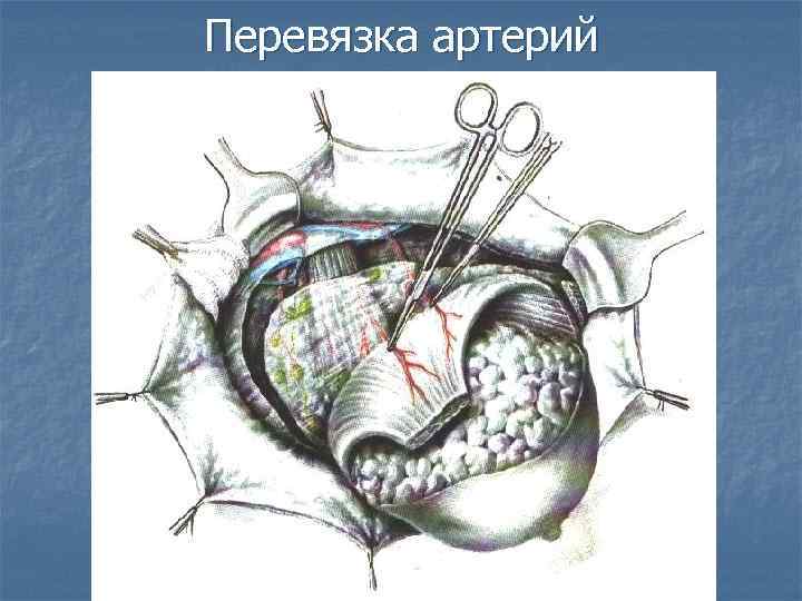 Перевязка артерий 