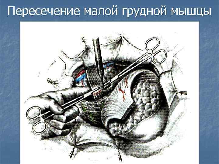 Пересечение малой грудной мышцы 