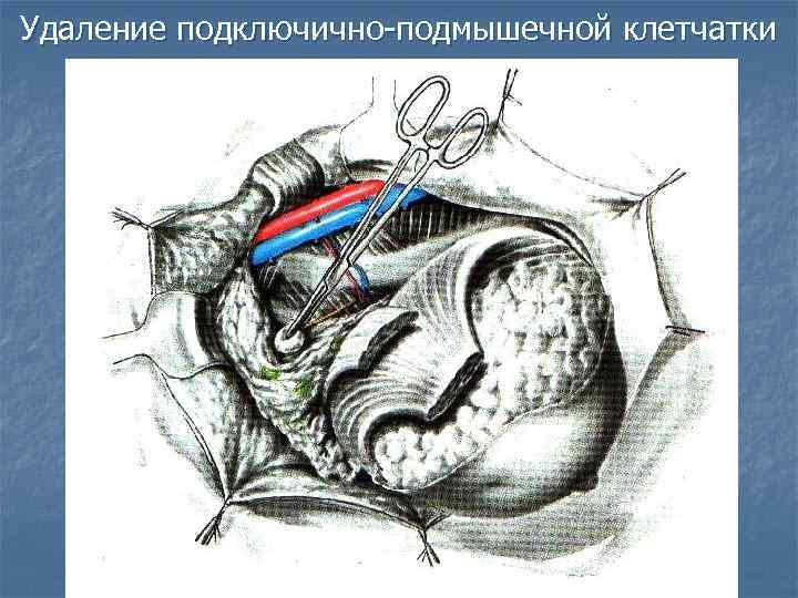 Удаление подключично-подмышечной клетчатки 