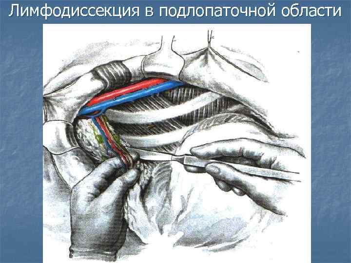 Лимфодиссекция в подлопаточной области 