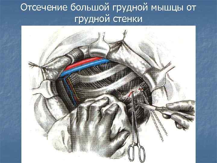 Отсечение большой грудной мышцы от грудной стенки 