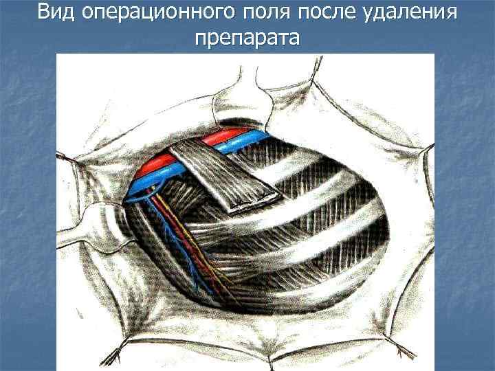 Вид операционного поля после удаления препарата 