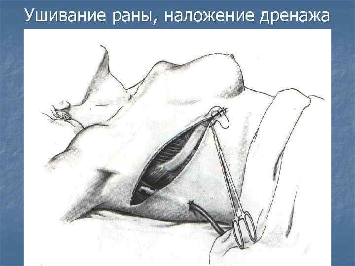 Ушивание раны, наложение дренажа 