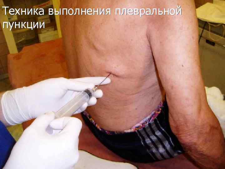Техника выполнения плевральной пункции 
