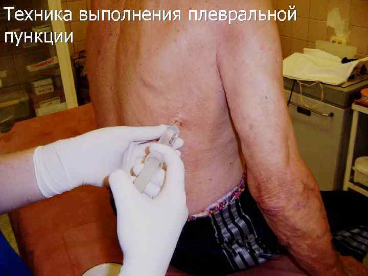 Техника выполнения плевральной пункции 