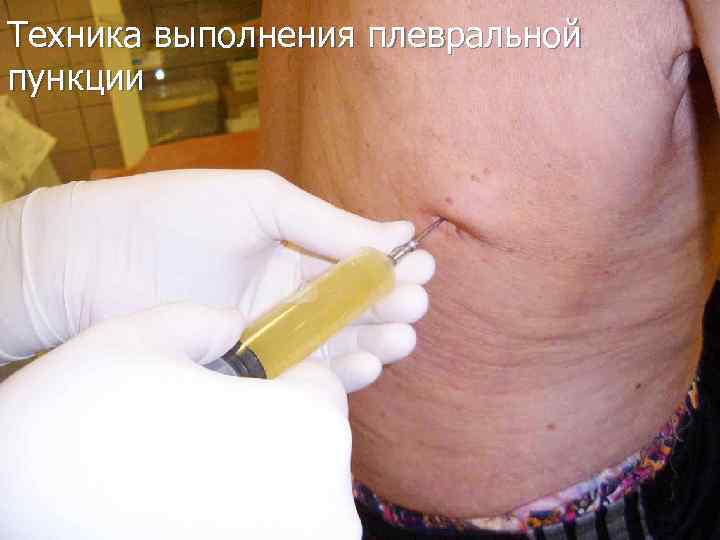 Техника выполнения плевральной пункции 