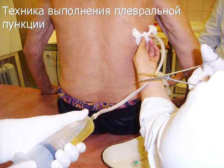 Техника выполнения плевральной пункции 