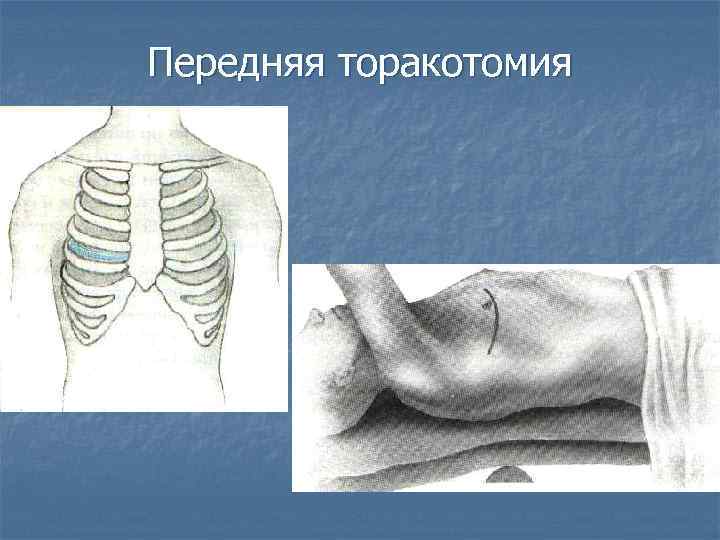 Передняя торакотомия 