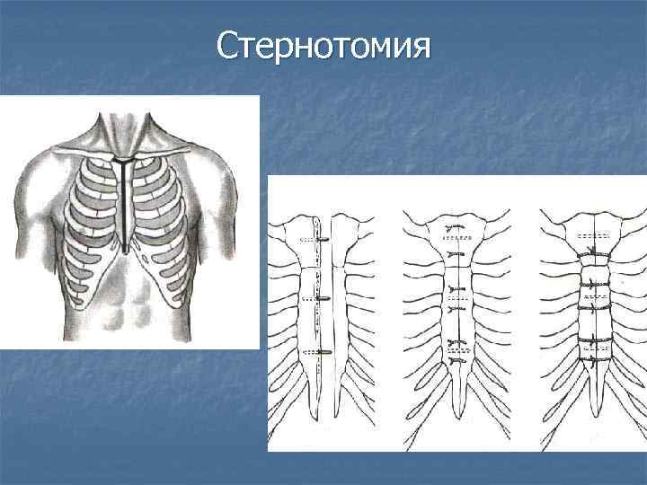 Стернотомия 