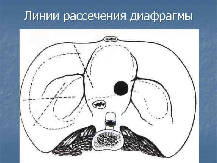 Линии рассечения диафрагмы 