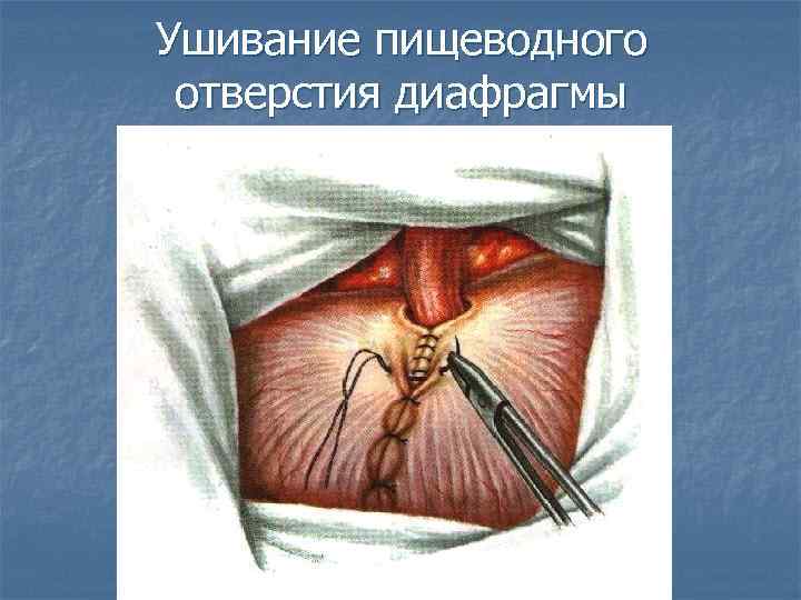 Ушивание пищеводного отверстия диафрагмы 
