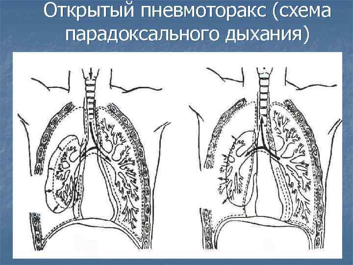 Открытый пневмоторакс (схема парадоксального дыхания) 