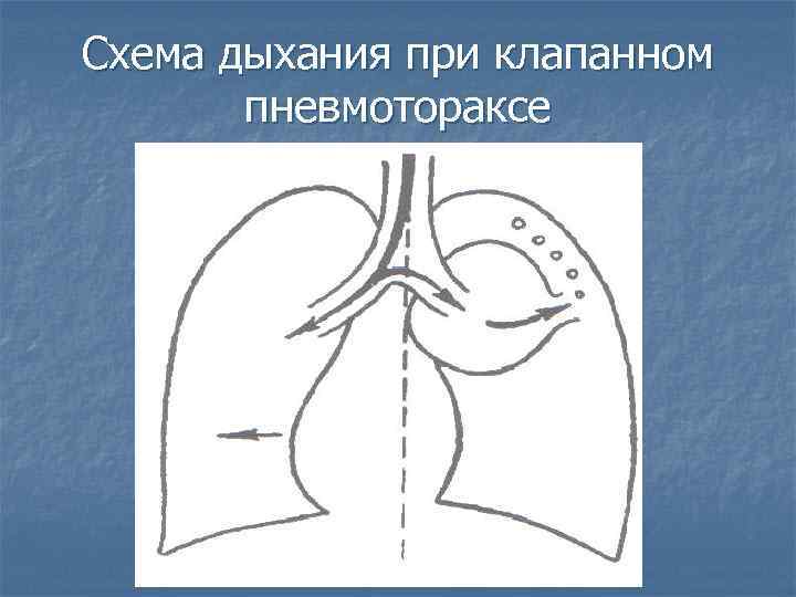 Схема дыхания при клапанном пневмотораксе 