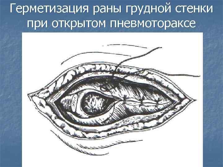 Герметизация раны грудной стенки при открытом пневмотораксе 