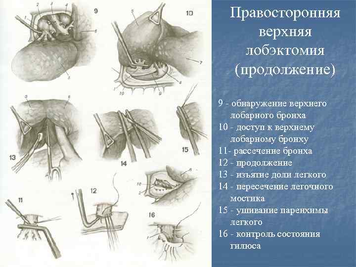 Удаление доли. Лобэктомия легкого ход операции. Лобэктомия легкого этапы. Лобэктомия и пневмонэктомия. Лобэктомия верхней доли легкого.