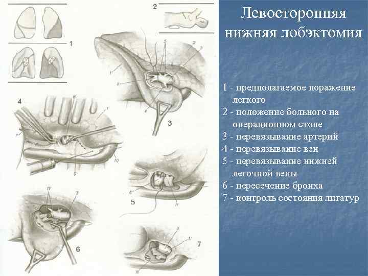 Операция нижняя. Лобэктомия этапы операции. Лобэктомия легкого операция техника. Лобэктомия техника операции. Лобэктомия схема операции.