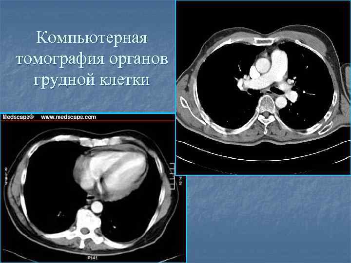 Компьютерная томография грудной клетки как подготовиться