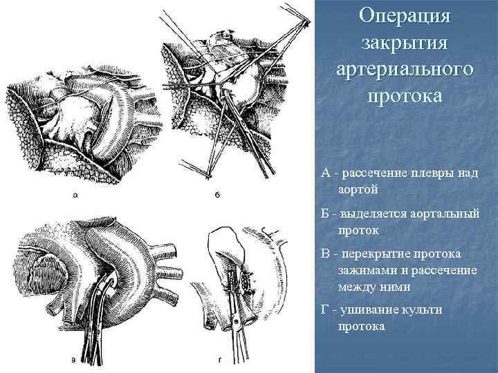 Операции топографическая анатомия. Операции при открытом артериальном протоке. Лигирование открытого артериального протока. Боталлов проток операция. Открытый артериальный проток операция.