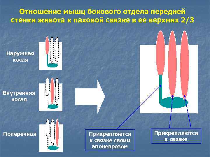 Отношение мышц бокового отдела передней стенки живота к паховой связке в ее верхних 2/3