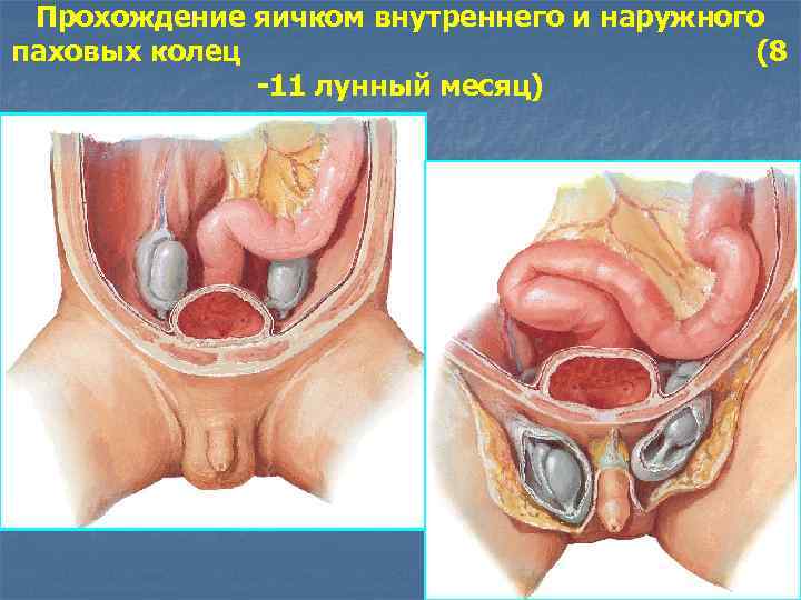 Прохождение яичком внутреннего и наружного паховых колец (8 -11 лунный месяц) 