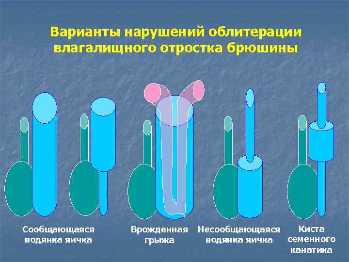 Варианты нарушений облитерации влагалищного отростка брюшины Сообщающаяся водянка яичка Врожденная грыжа Киста Несообщающаяся семенного