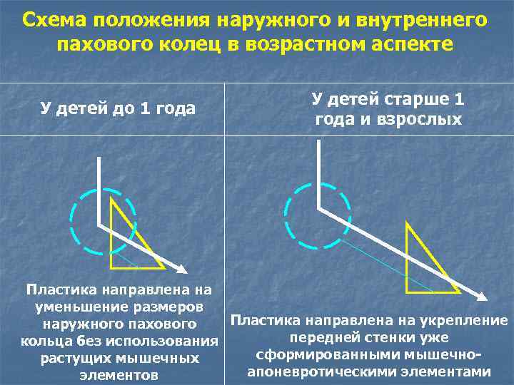 Схема положения наружного и внутреннего пахового колец в возрастном аспекте У детей до 1