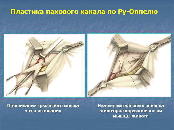 Схемы пластики пахового канала