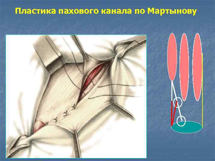 Паховый канал у детей. Пластика передней стенки паховой грыжи. Грыжесечение паховой грыжи по Мартынову. Пластика о Мартынову - паховая грыжа.