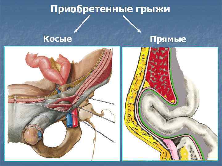 Приобретенные грыжи Косые Прямые 