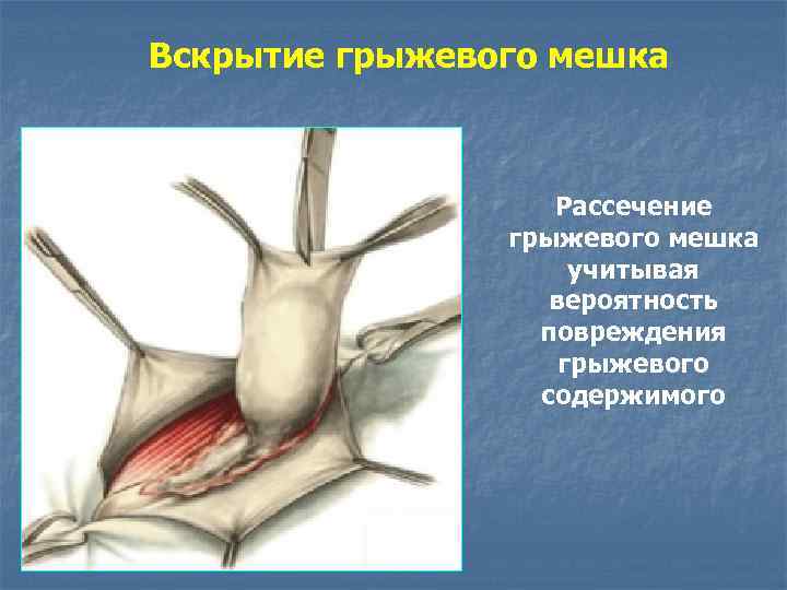 Вскрытие грыжевого мешка Рассечение грыжевого мешка учитывая вероятность повреждения грыжевого содержимого 