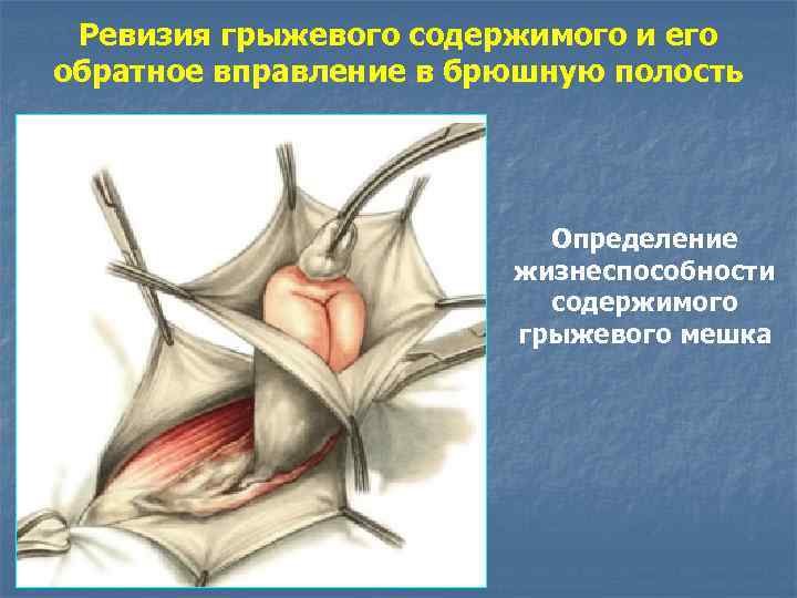 Ревизия грыжевого содержимого и его обратное вправление в брюшную полость Определение жизнеспособности содержимого грыжевого