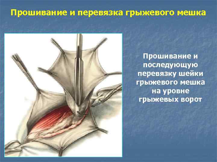 Прошивание и перевязка грыжевого мешка Прошивание и последующую перевязку шейки грыжевого мешка на уровне