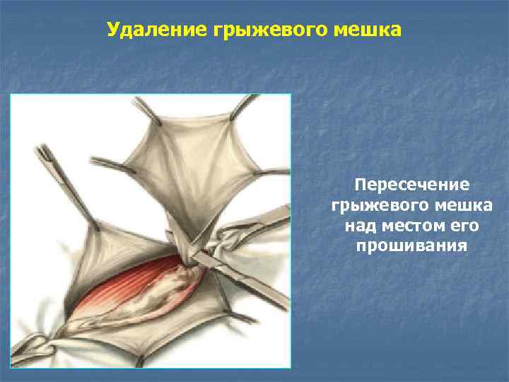 Удаление грыжевого мешка Пересечение грыжевого мешка над местом его прошивания 