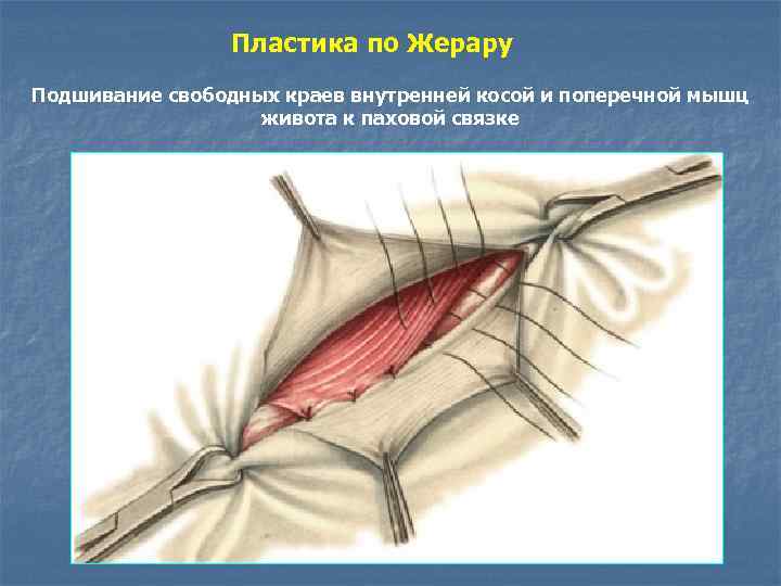 Грыжа передней брюшной стенки