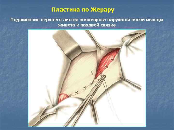 Пластика по Жерару Подшивание верхнего листка апоневроза наружной косой мышцы живота к паховой связке