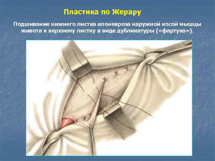 Пластика по Жерару Подшивание нижнего листка апоневроза наружной косой мышцы живота к верхнему листку