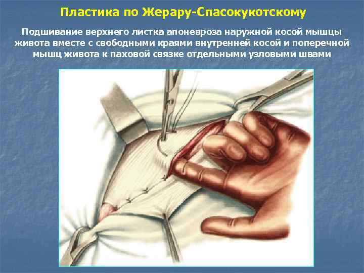 Пластика по Жерару-Спасокукотскому Подшивание верхнего листка апоневроза наружной косой мышцы живота вместе с свободными