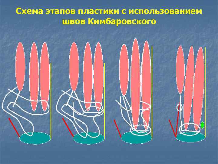 Пластика пахового канала по кимбаровскому